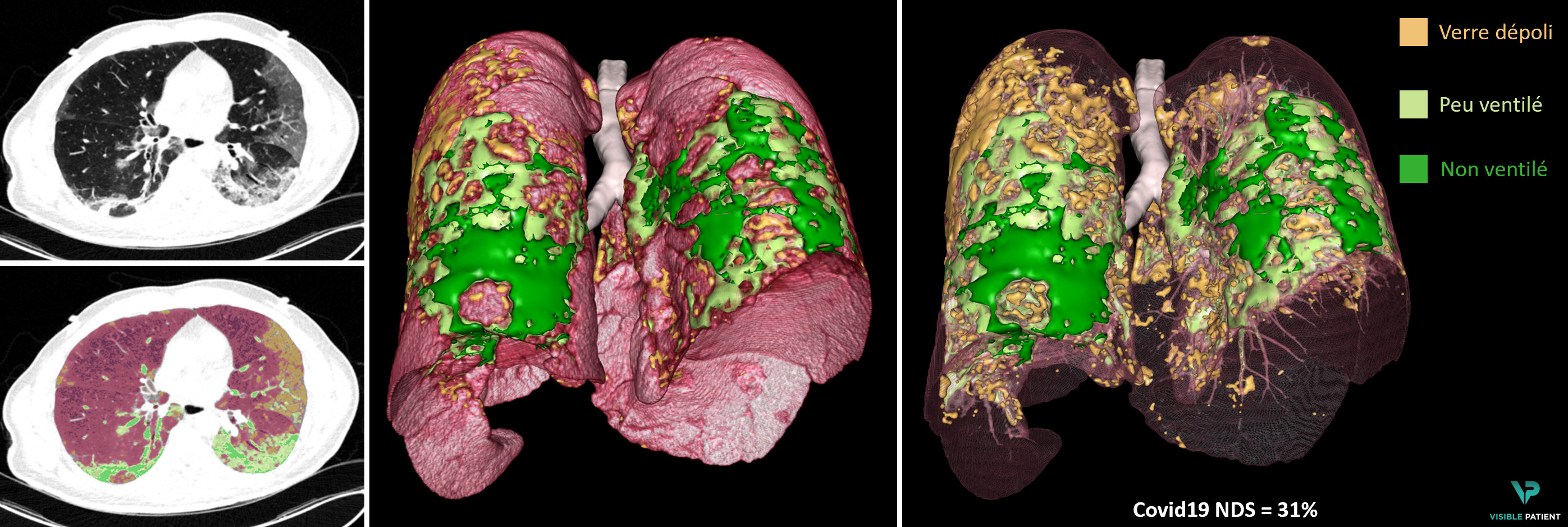 3D model of pathological areas