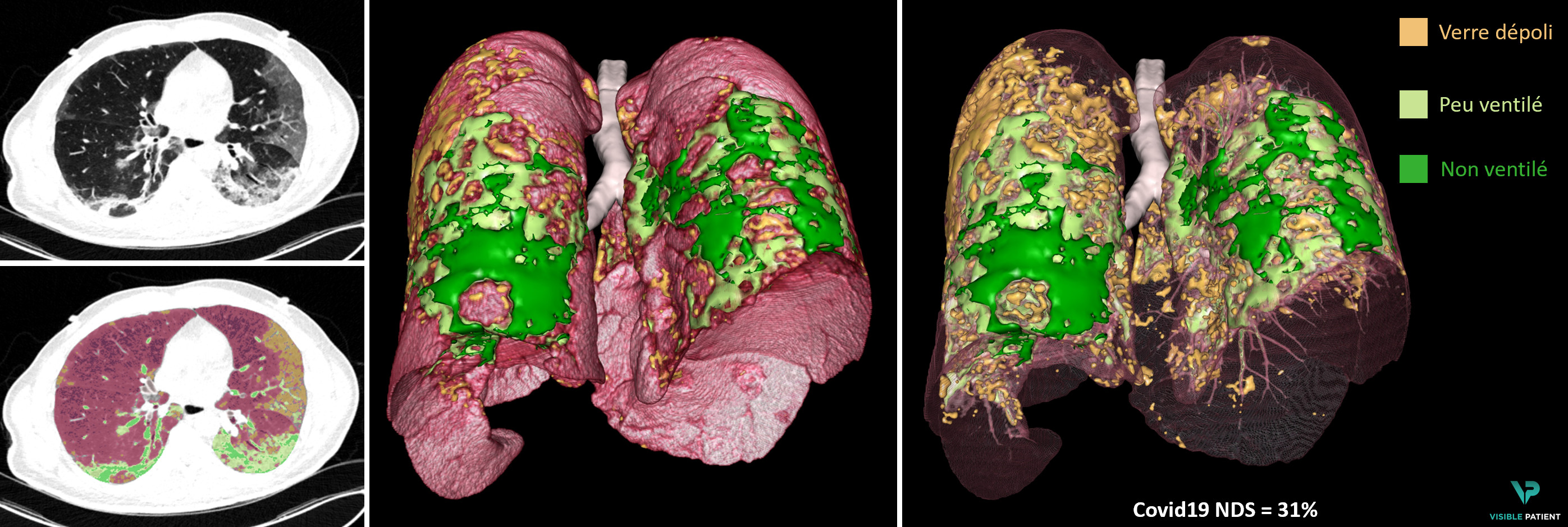 Modélisation 3D des zones pathologiques